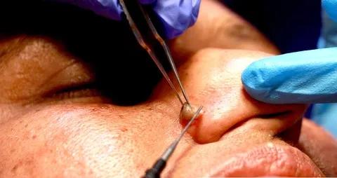 Keloid Scars, Mole or Freckles Removal