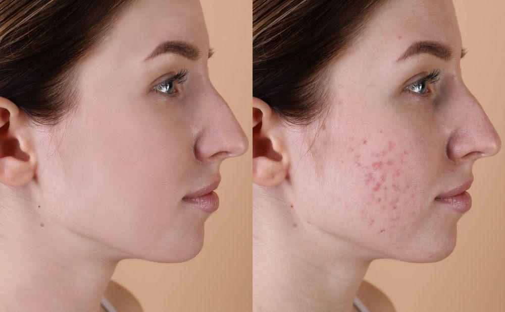 Acne scars image before after.jpg